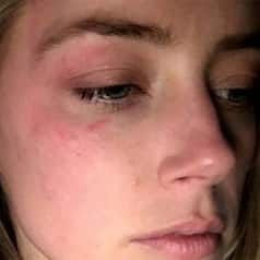 OMG! Amber Heard releases images of alleged physical abuse by Johnny Depp in court