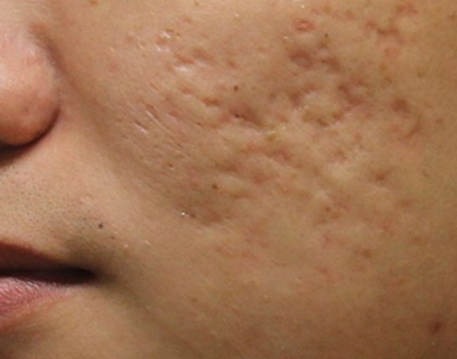 Cocoa butter can treat your scars, rashes, infections and burns