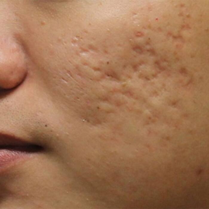 Cocoa butter can treat your scars, rashes, infections and burns