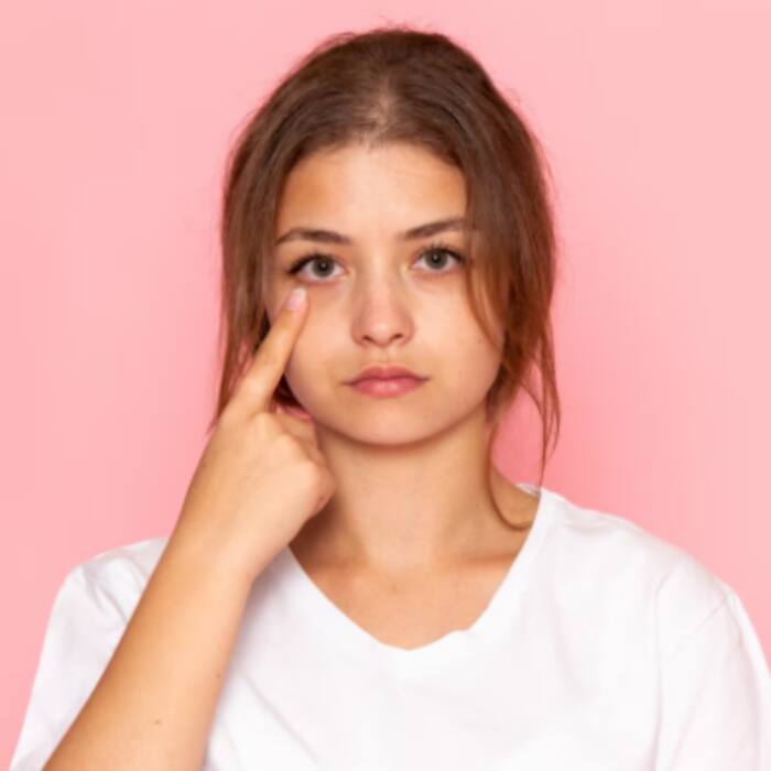 Dark circles