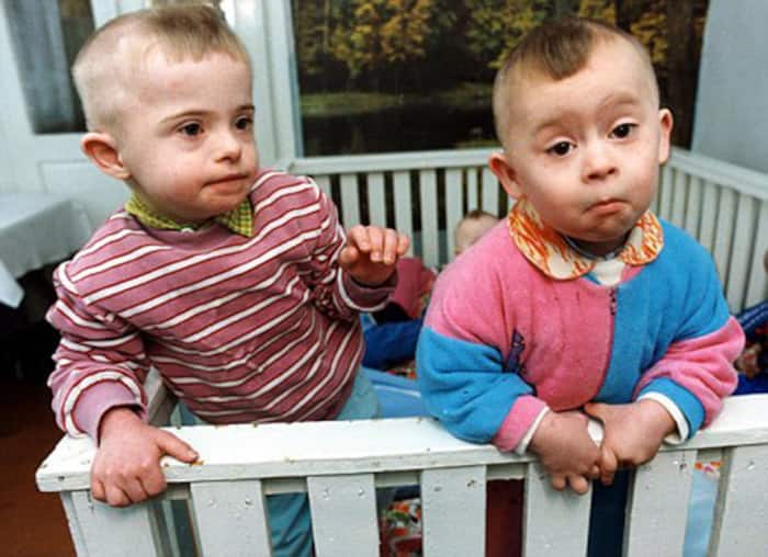 Diseases that are common in Down Syndrome patients