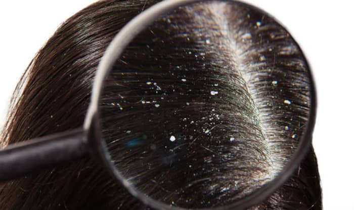 Helps Get Rid of Dandruff