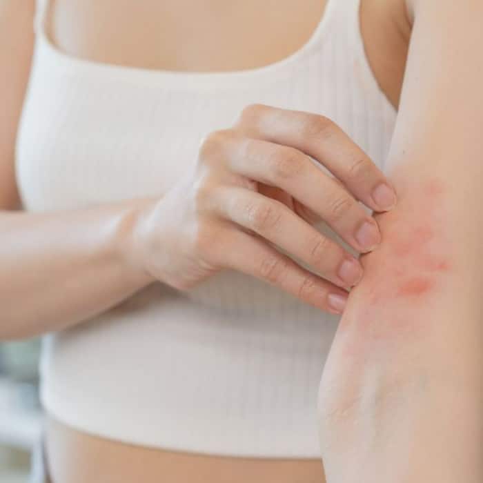 Itchy skin and easy bruising