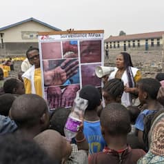 Mpox Cases on Rise: Vaccine to First Symptoms, 6 Essential Things to Know About This Global Health Scare