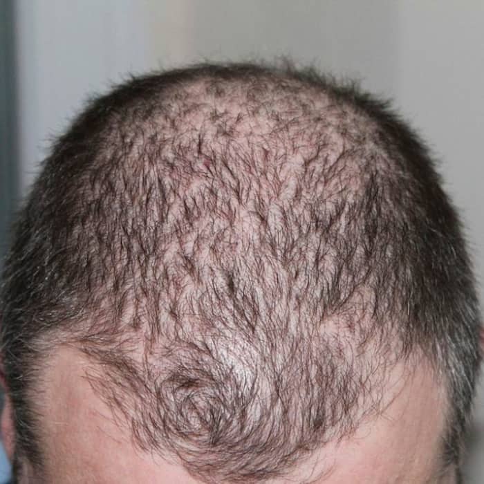 Onion Juice for Hair Growth