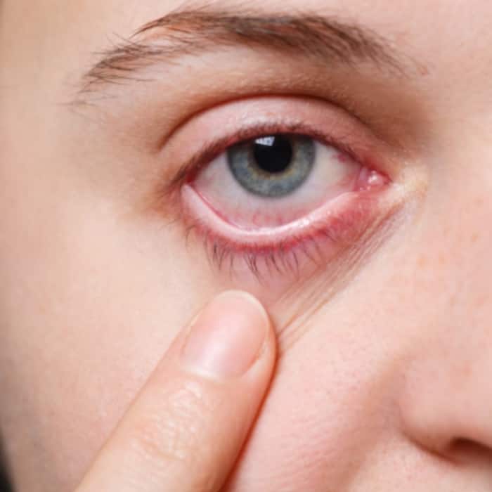 Redness and irritation