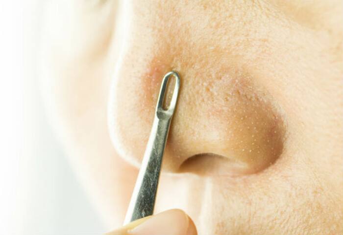 Removes blackheads