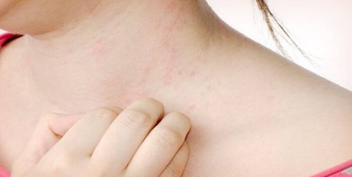 Home Remedies For Rashes: Here Are Some Natural Alternatives For Skin ...