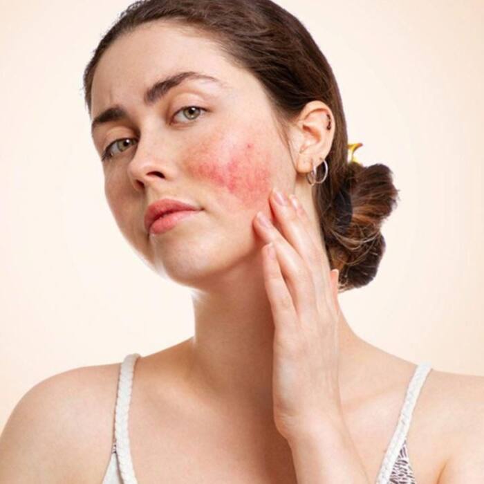 Skin Breakouts And Redness