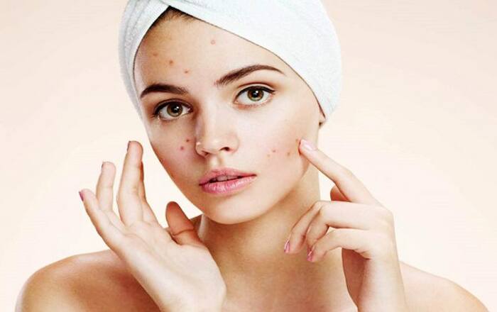 Treats acne
