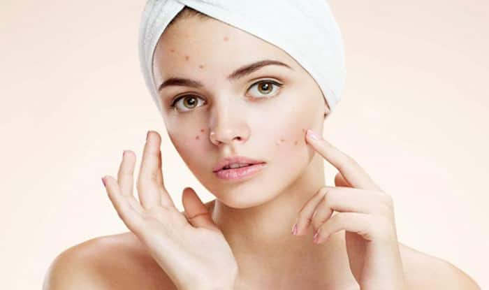 Treats Acne