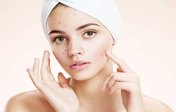 Treats Acne