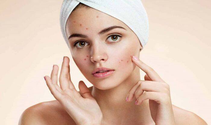 Treats Acne
