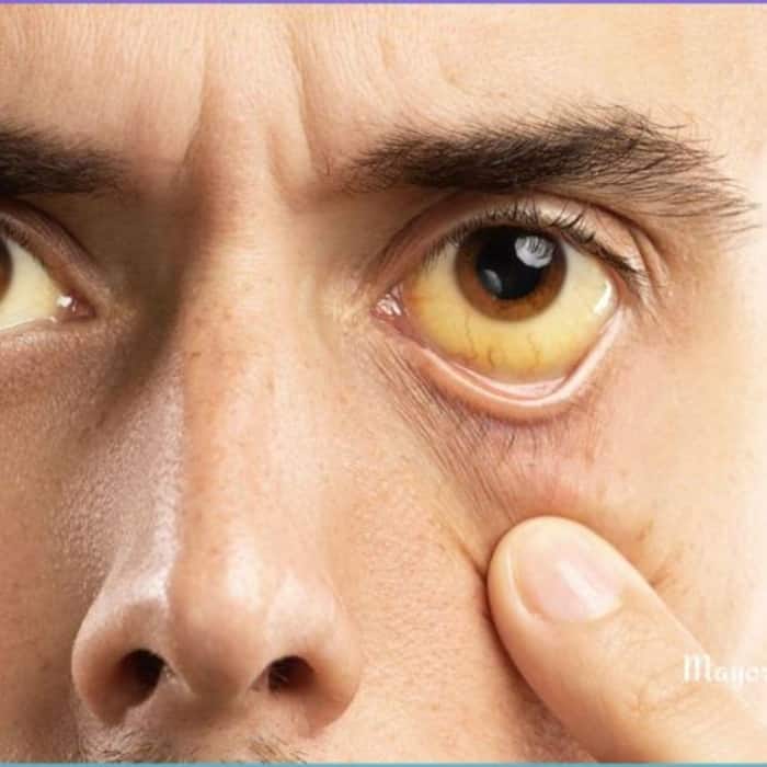 Yellow skin or eyes